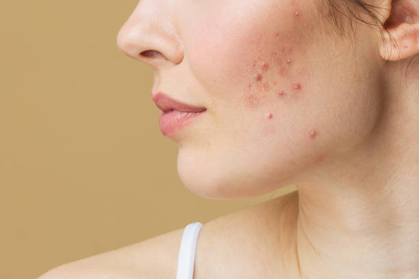 herbal acne solutions
